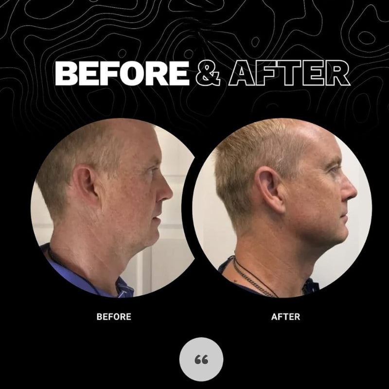 JawSculptr™ – The Ultimate Jawline Shaper